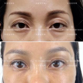 变“肥”为宝 | 自体脂肪移植术让脂肪也能“搬家”