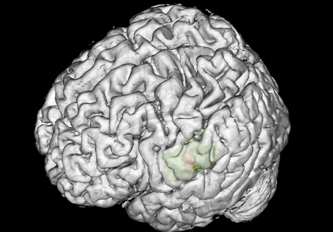 我院神经外科完成首例术中唤醒脑功能区癫痫病灶切除手术