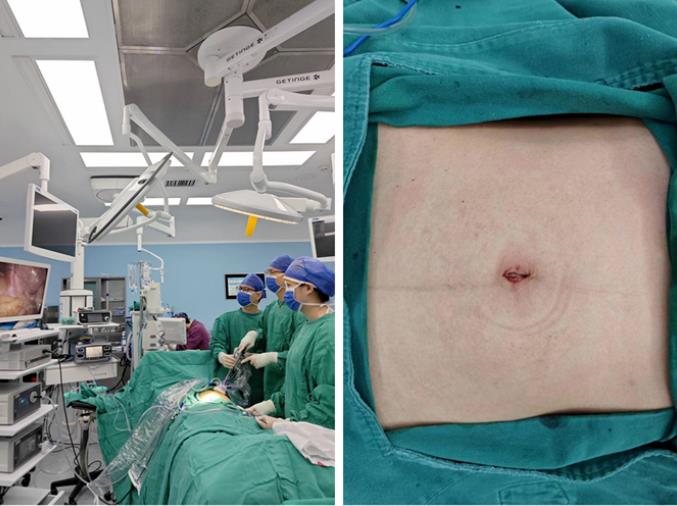 老虎机app
单孔腹腔镜术助患者实现“术后无痕”