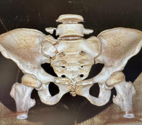 老虎机app
骨折微创固定技术大显身手