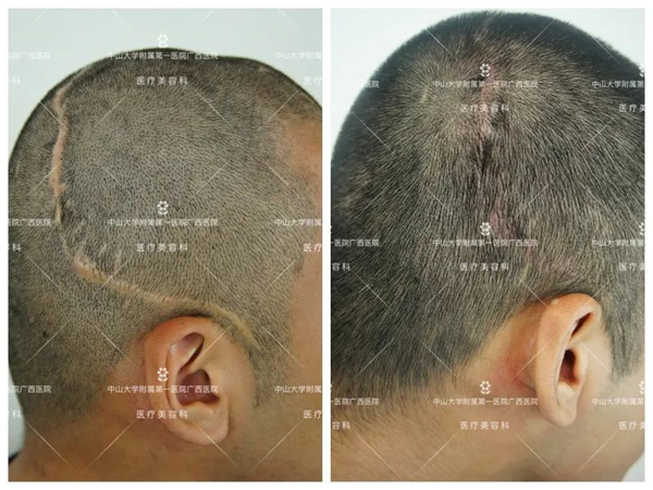 头上的疤痕可以用植发补救吗?老虎机app
自体毛发移植术助患者解决“头等大事”