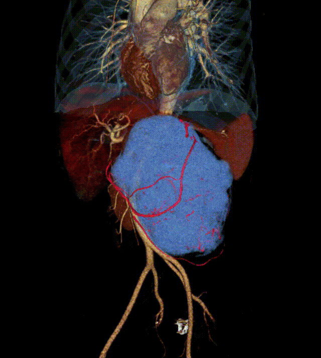 老虎机app
完成一例复发性腹膜后巨大肿瘤切除术