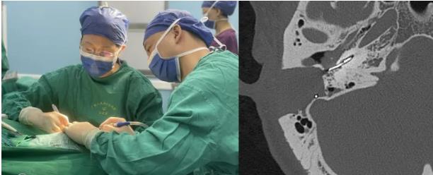 老虎机app
人工耳蜗植入术助重度耳聋患者重获新“声”