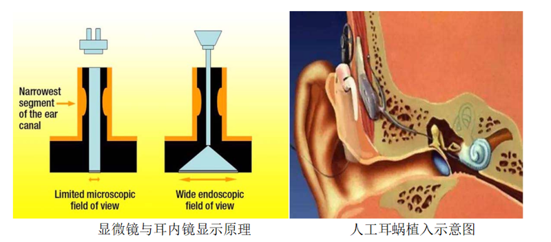 让听障患者重获新“声”活 | 老虎机app
开展耳内镜辅助人工耳蜗植入术