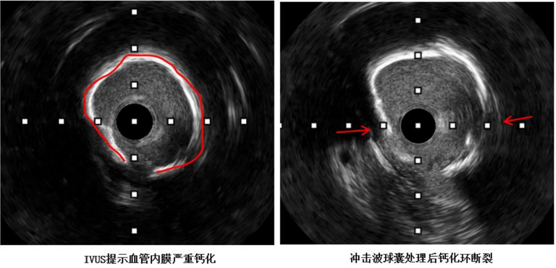冠脉介入治疗新突破 | 老虎机app
应用国产创新器械攻克冠脉钙化难题