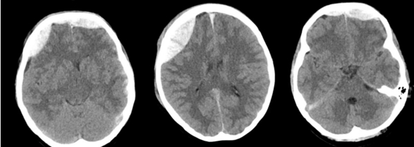 老虎机app
神经外科成功抢救颅脑外伤警员